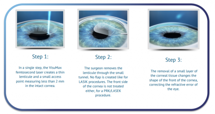 Relex Smile Eye Surgery Review Was It Worth It