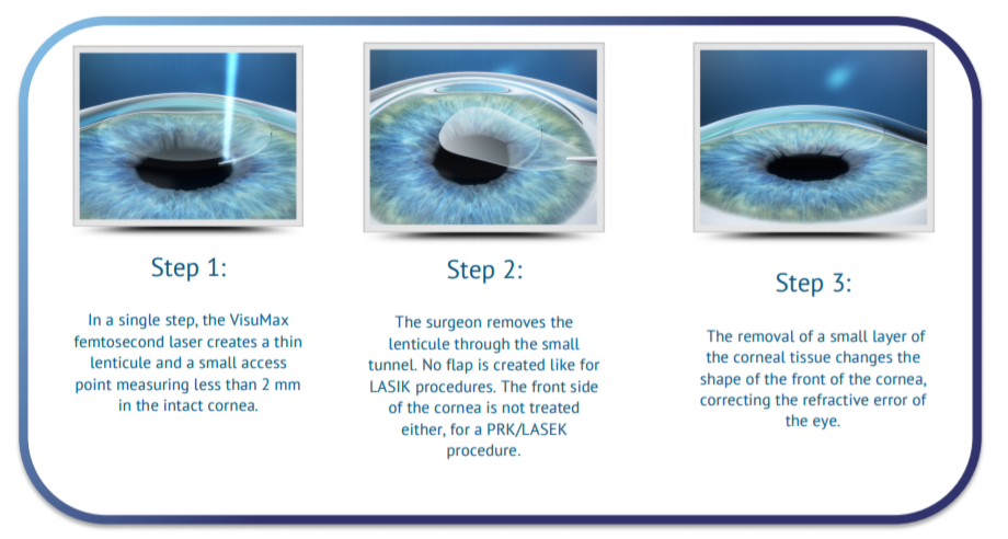 smile eye surgery side effects